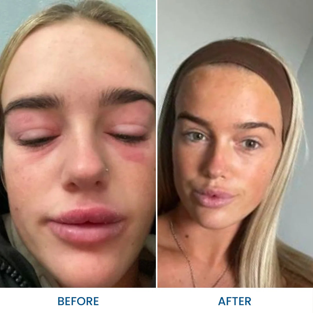 Face Eczema Bundle