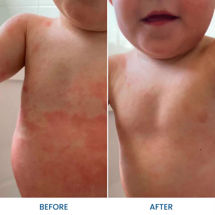 Baby Eczema Pack