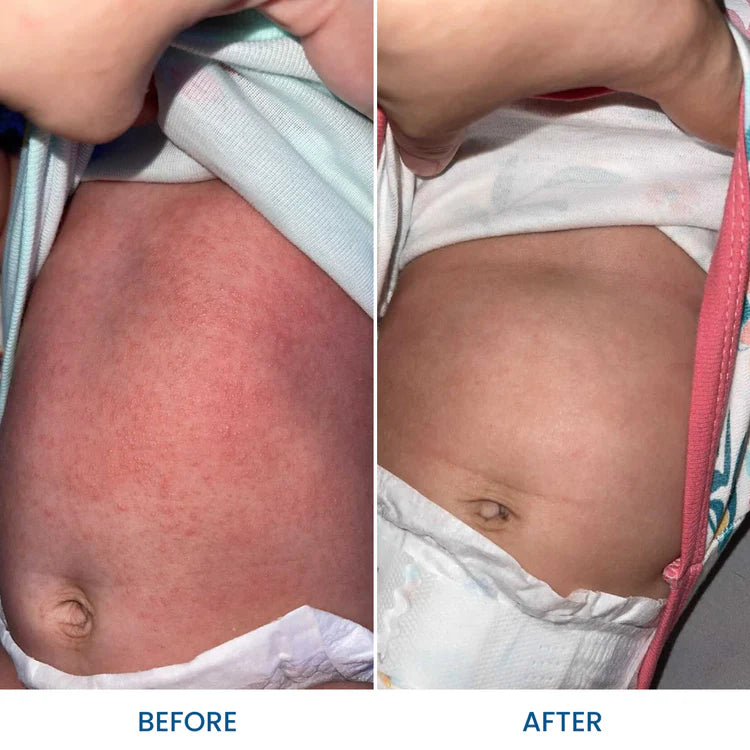 Baby Eczema Pack