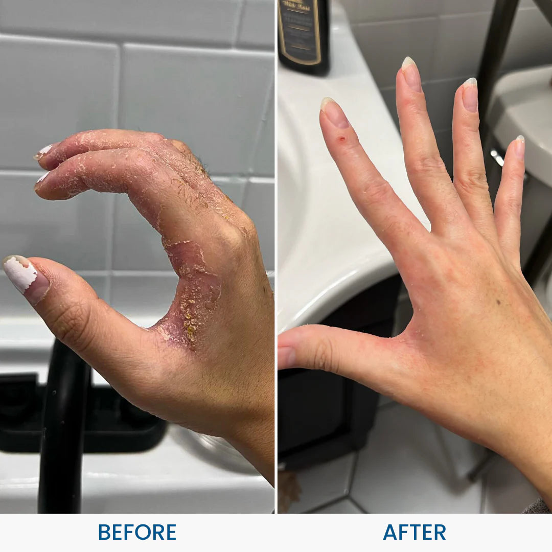 C+ Eczema Dermatitis Cream