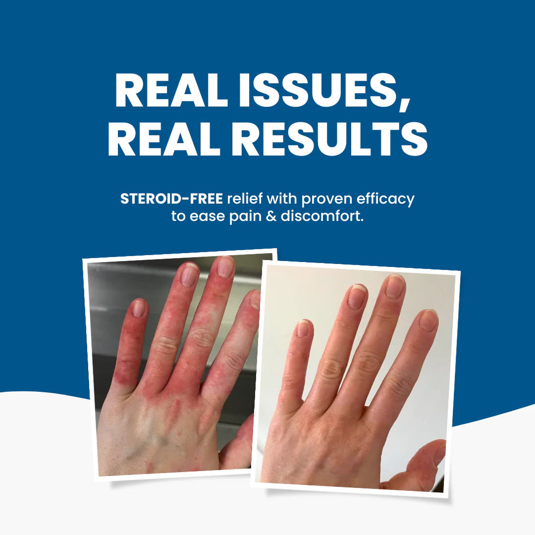 C+ Eczema Dermatitis Cream