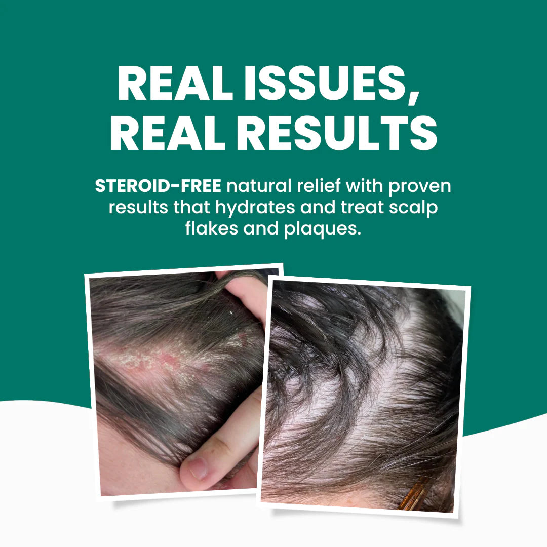 Scalp Relief Plus Bundle