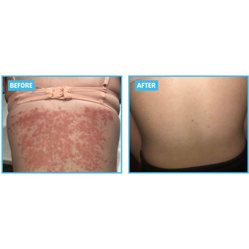 Psoriasis Cream