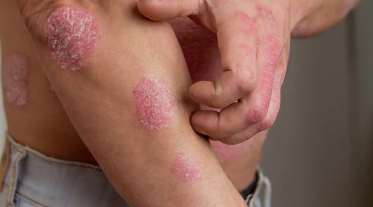 Living with Psoriasis? Treatments, Causes and Triggers.