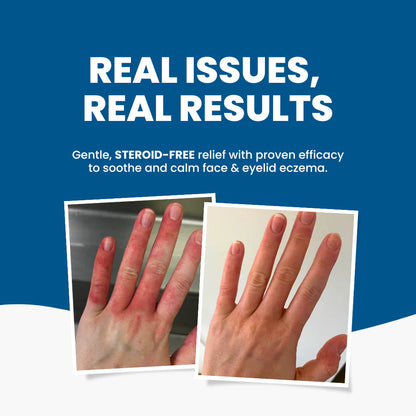 Eczema Bundle